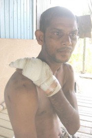 Yoanichandra ‘Nadesh’ Bisram, with his bandaged hand, showing some of the marks on his body. 