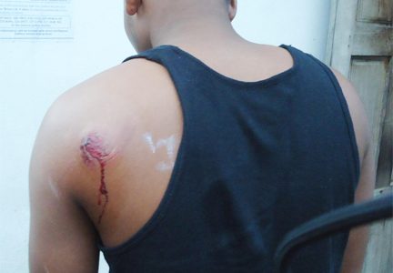 Stephen Singh, who was among five arrested for the killing of alleged burglar Kurt Mayers, shows his injury.