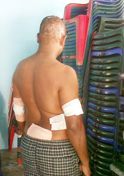 Navindra Kumar shows his treated wounds yesterday after he was attacked by at least seven men while trying to protect his brother, Kumar Mohabir who was fatally stabbed on Saturday.  