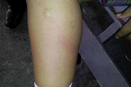 The red mark on the leg indicating where Tecoma Armstrong says she was hit with a piece of wood by a teacher at the Tucville Secondary School.