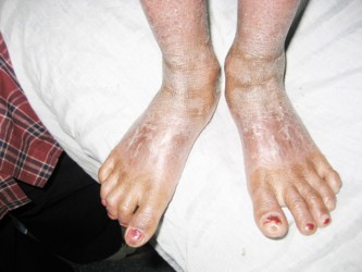 This is what the condition has done to Sasha’s feet.