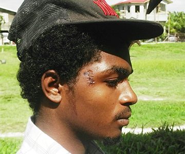 Shaquille Chester showing his injuries at his Sophia home.
