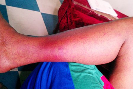 Ann Mentis: Ann Mentis’ left leg was swollen and covered in red spots yesterday when Stabroek News visited her home at Howes Street, Charlestown. 