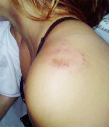 One of the several bruises on the young woman’s shoulder