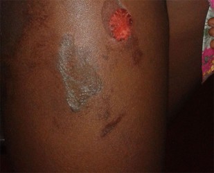 The burns on the front of the 12-year-old’s right leg. 