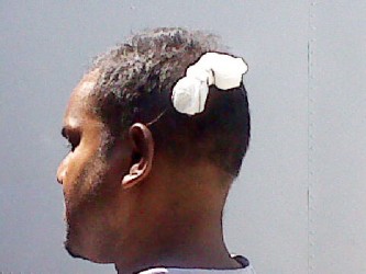 Asif Masode Khan’s bandaged head 