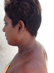 Geeta Boodhoo with the scars visible on her neck and shoulder.