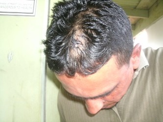 Faizal Hussain showing the lacerations he suffered in the head as a result of being gun-butted by the bandits.