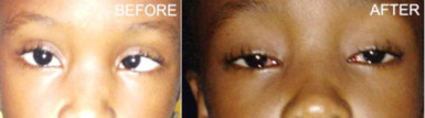 An eight-year-old patient, before and after her surgery by the visiting team of Trinidadian doctors at the GPHC (GINA photo)