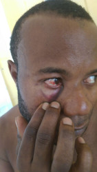 Maxwell Boston showing an injury to his eye 