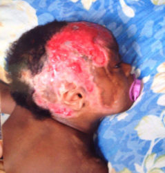 The burns Rania sustained to the right side of her face.