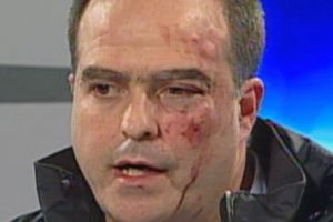 A bruised Julio Borges