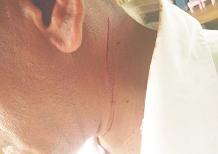One of the slashes sustained by the Head Teacher of the Wauna Primary School during an attack by the sibling of a student. 