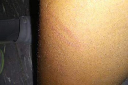 This photo, provided by Ann-Marie James, shows marks on the skin of her daughter, Moesha James, allegedly from a beating inflicted by a coach at Vere Technical High School.