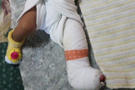 The cast placed on the baby’s leg
