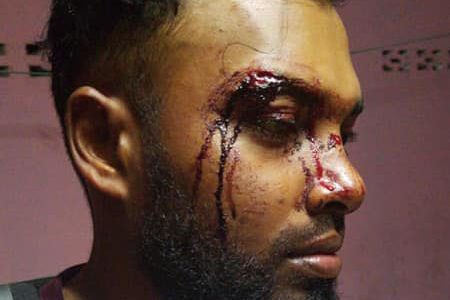Naime Sabar displaying injuries he sustained to his face during the attack. 