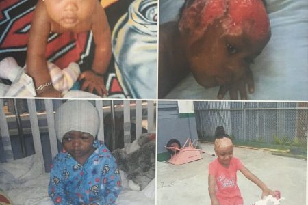 Ranie Rogers – the top left photo shows her before the incident occurred; the top right photo shows her after the burns. The bottom left photo shows Ranie after her first set of surgeries while the bottom right photo shows Ranie, now six years old.