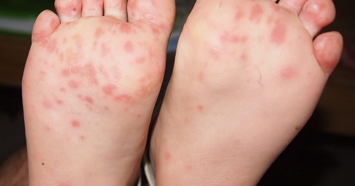Hand, Foot And Mouth Disease