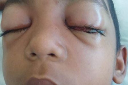 The eight-year-old just days after he was admitted to the hospital as both his eyes were swollen shut.