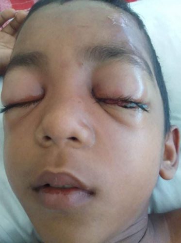 The 8-year-old in the Georgetown Public Hospital with his eyes swollen shut 