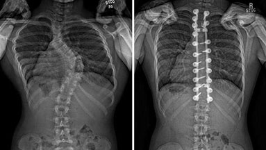 X-rays show the spine with and without scoliosis.