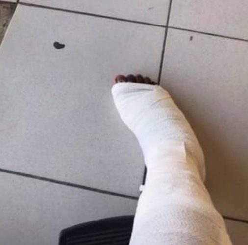 Nicardo’s right leg is now in a cast, after being bitten by crocodile.