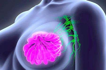 Breast cancer is the leading cause of cancer deaths in Jamaican women.
