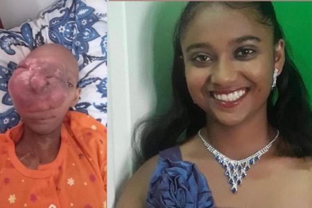 A composite photo shows Shaniece Nanhoe after and before the facial cancer growth