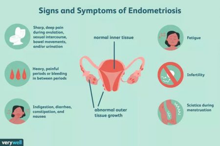 A diagram explaining the signs and symptoms of endometriosis