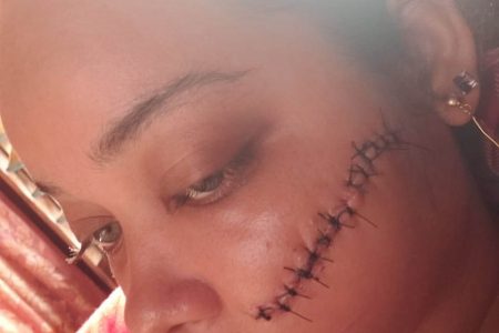 Rezana Rahaman’s injured face with the stitches