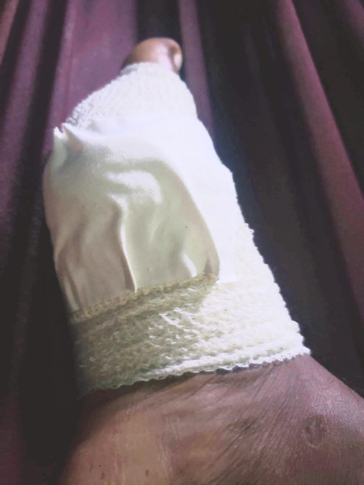 Ravindra Compton’s swollen foot in bandages 
