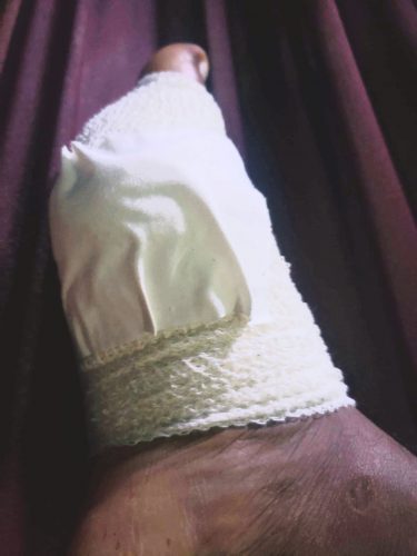 The bandaged foot of Ravindra Compton after the alleged piranha attack